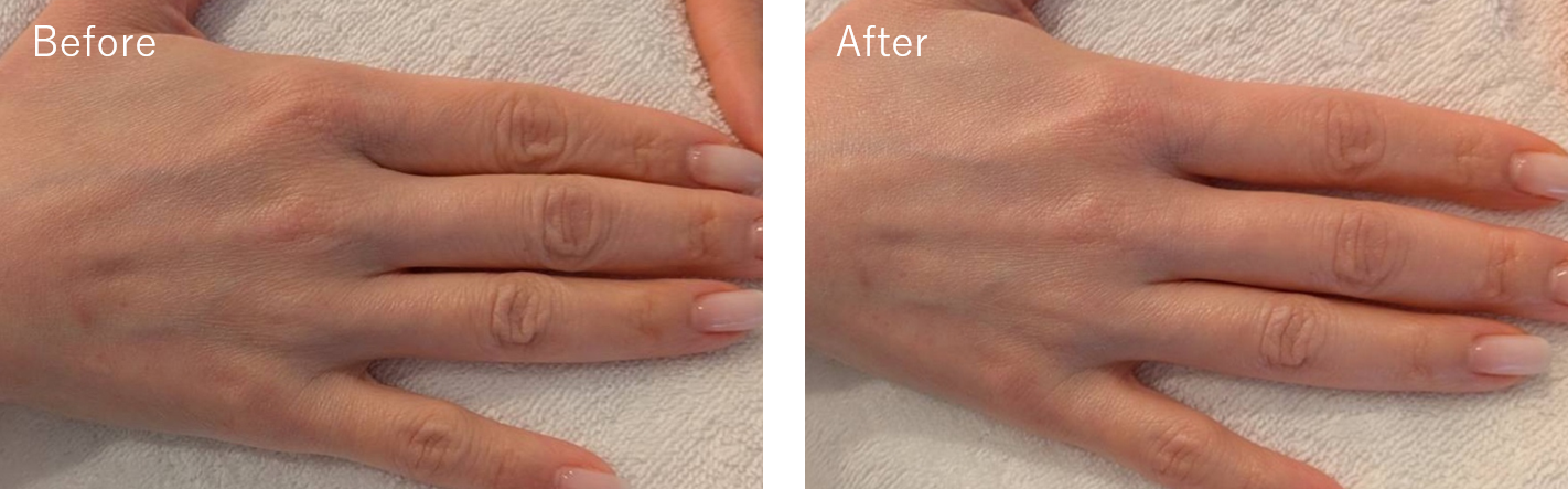IPL-hand